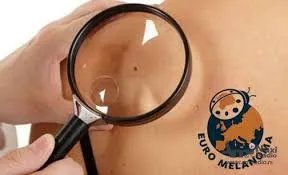 Kampanja „Euromelanom 2023“: Besplatan skrining pregleda 15. maja u Opštoj bolnici